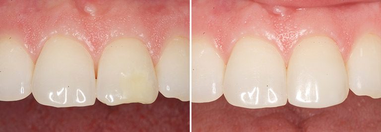 Cosmetic Bonding Before and After