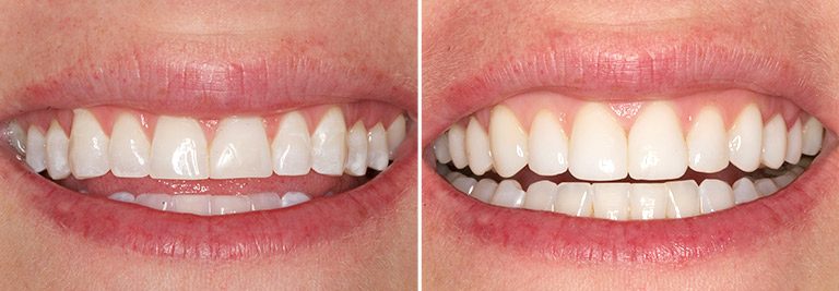 Cosmetic Bonding Before and After