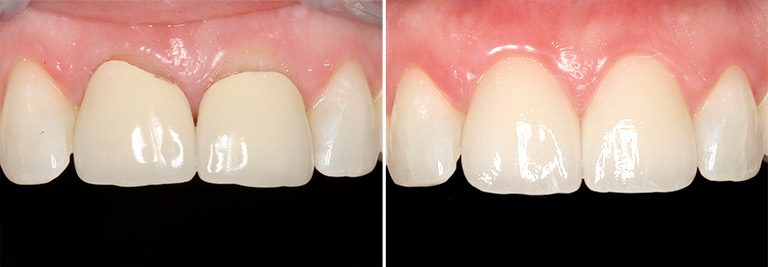 Cosmetic Crowns Before and After