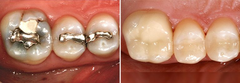 FIllings before and after